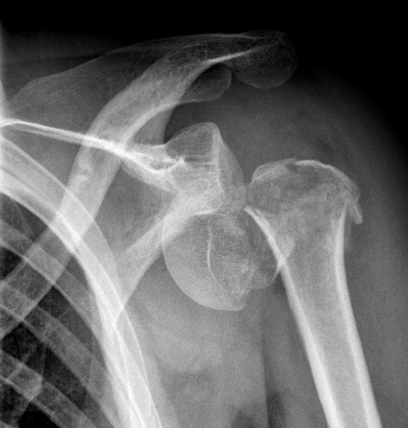 Fracture de l'humérus