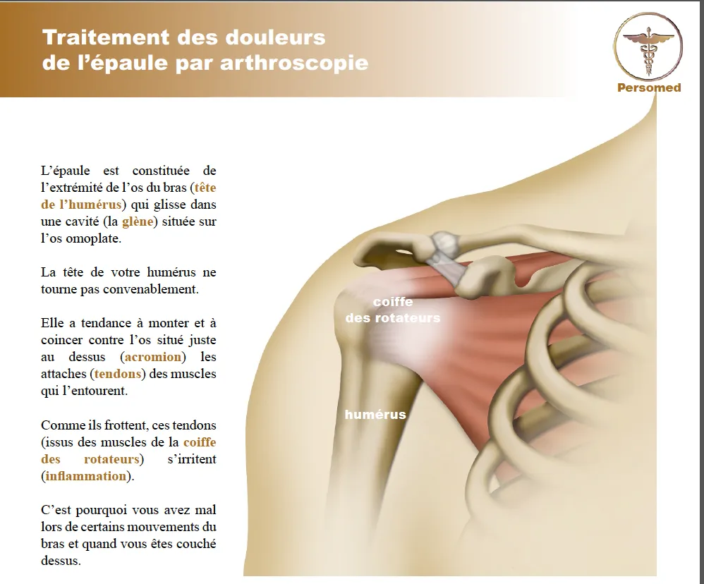 Livret traitement des douleurs de l’épaule par arthroscopie