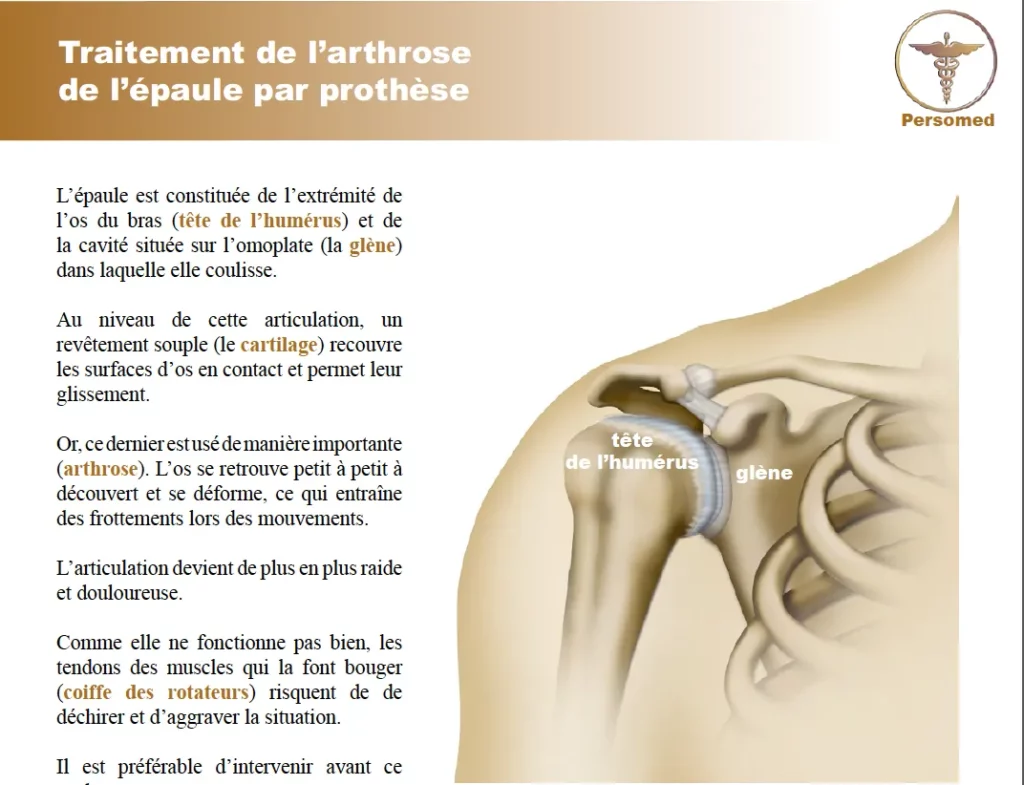 Livret traitement de l’arthrose de l’épaule par prothèse