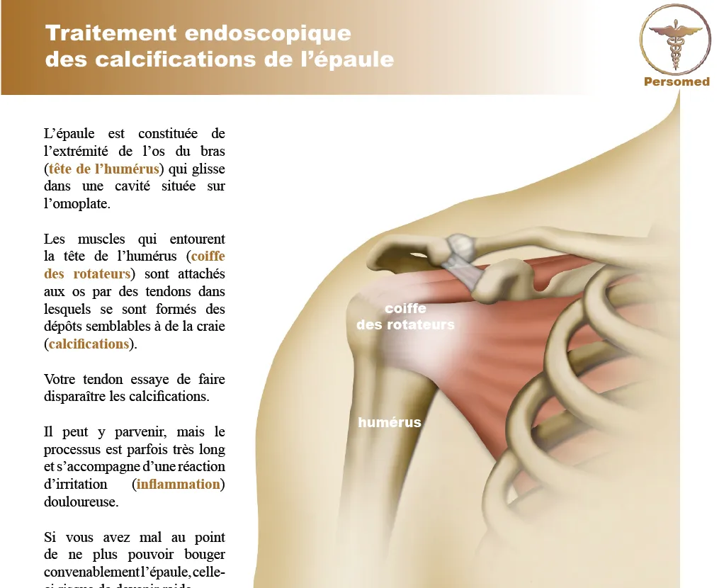 Livret traitement endoscopique des calcifications de l’épaule