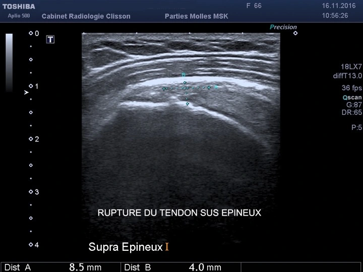 echographie rupture sus épineux