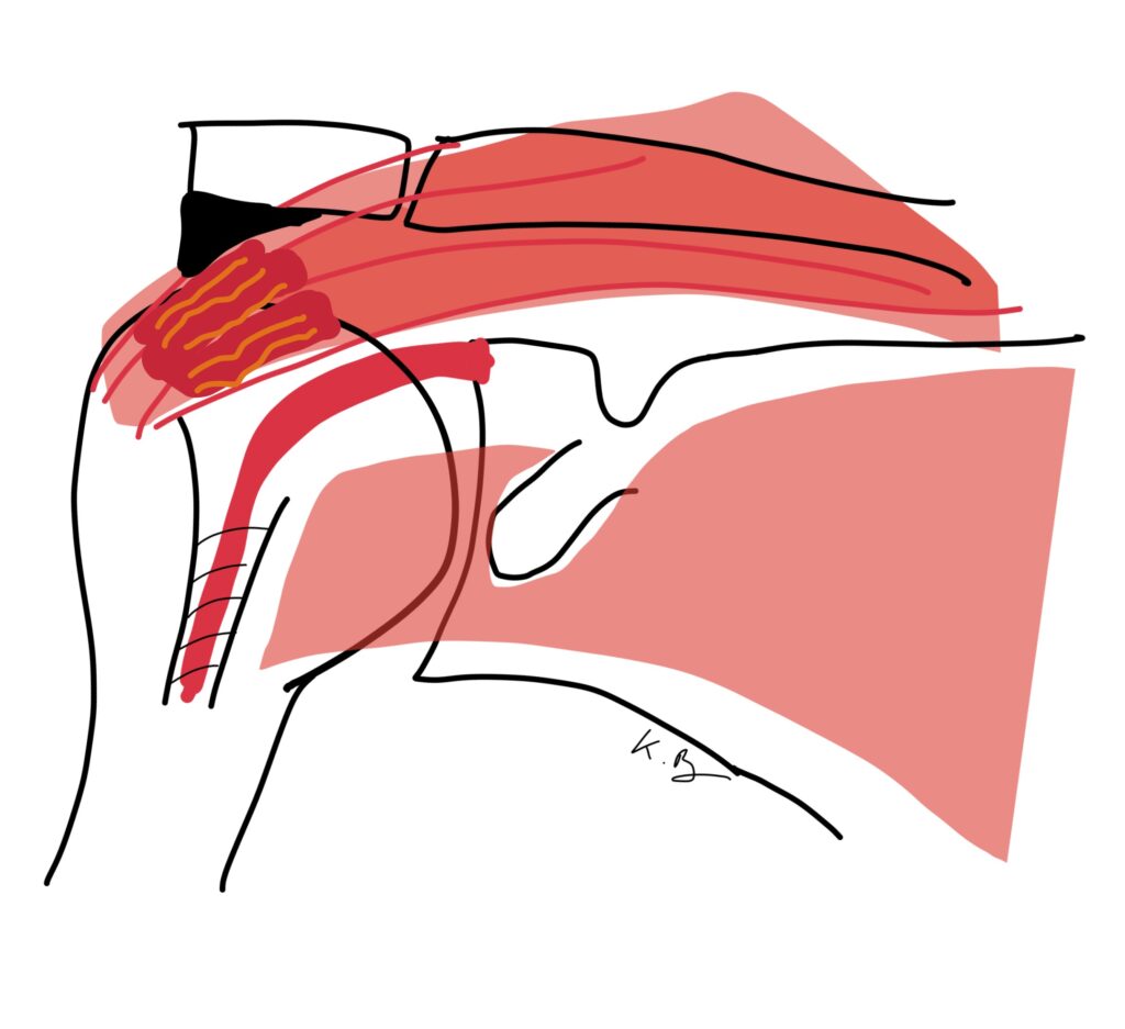 Épaule Face muscles Susep TLB