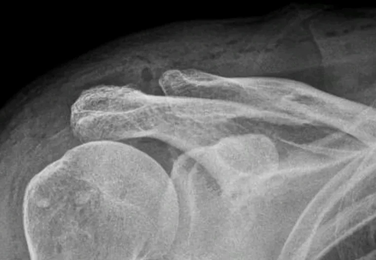 Arthroses acromio-claviculaire