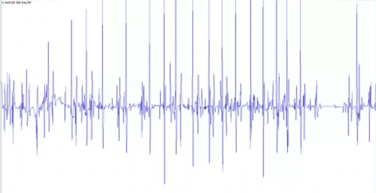 diagnostic epicondylite