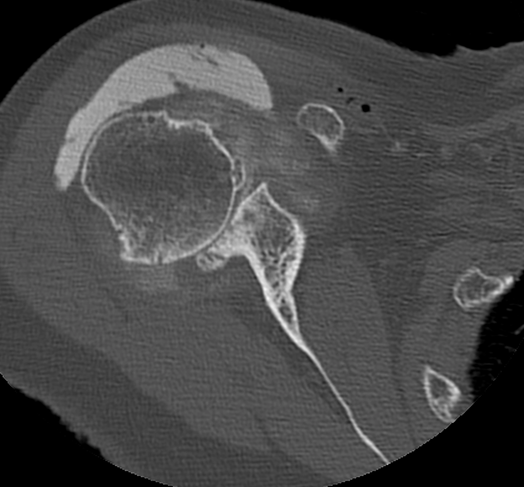 radio arthrose épaule