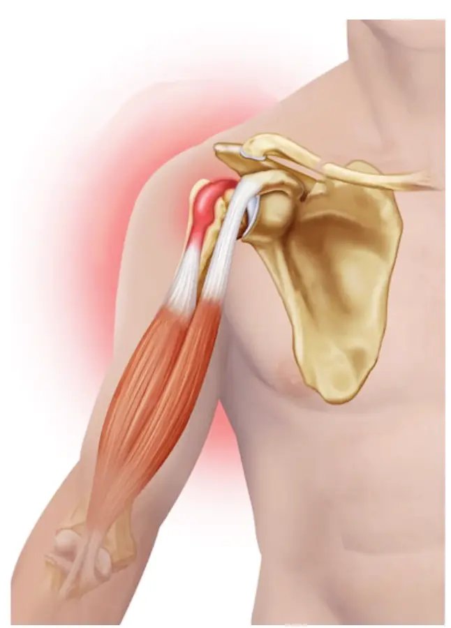 tendinite biceps modifié